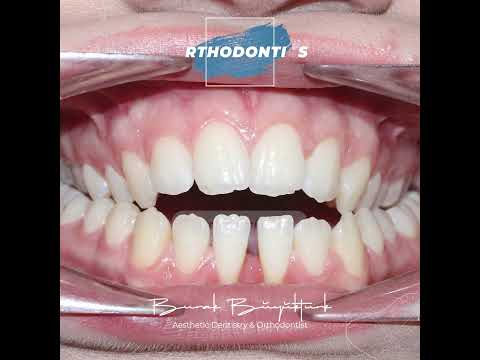 Anterior open bite treatment with #Orthodontic | Dr.Burak Büyüktürk