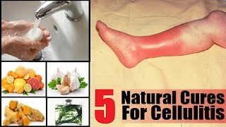 5 Home Remedies to Get Rid of Cellulitis Infection | By Top 5.