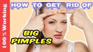 How To Get Rid Of Big Pimples Overnight - Fast - Home Remedies - Blackheads - Acne - Remove