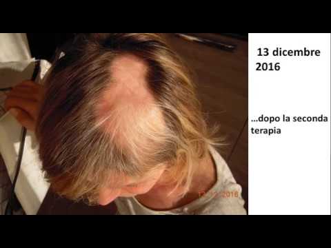 Uovo contro psoriasi La psoriasi perché sono ammalati