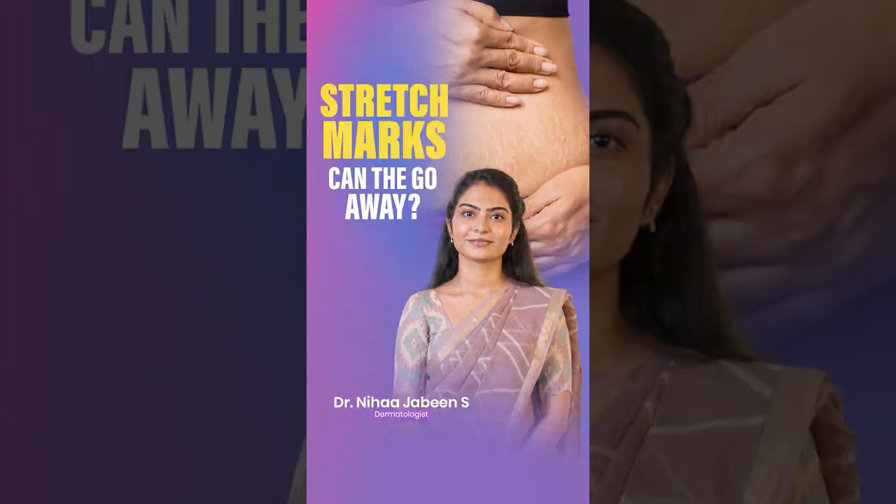 Stretch Marks: Can They Go Away? #dermatologistskincare #stretchmarksremoval