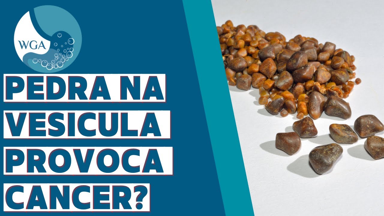 PERIGO DA PEDRA NA VESÍCULA - SERÁ QUE CAUSA CÂNCER?!