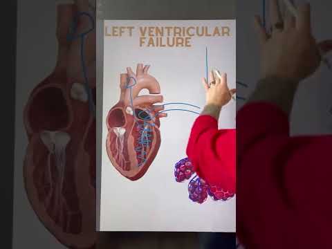 Left Ventricular Failure