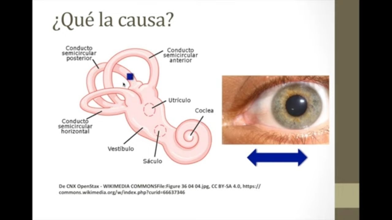 ¿Qué es el vértigo paroxístico benigno