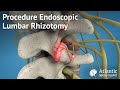 Procedure Endoscopic Lumbar Rhizotomy