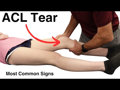 Modified Lachman s Test On a patient with a COMPLETE ACL TEAR