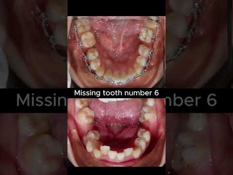 Missing Braces Around Initializer