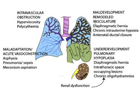 Persistent Pulmonary Hypertension of the Newborn by Dr Musa Nhlapo.