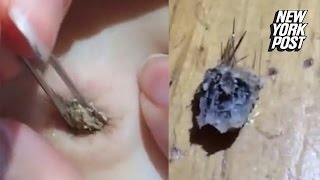 Girl removes gigantic hairy blackhead from her bel