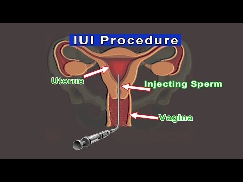 Iui intrauterine insemination