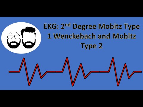 EKG Series: 2nd Degree AV Blocks: Mobitz Type 1 (Wenckebach) and Mobitz Type 2
