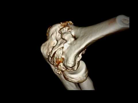 Severe Degenerated Osteoarthritis of the Elbow