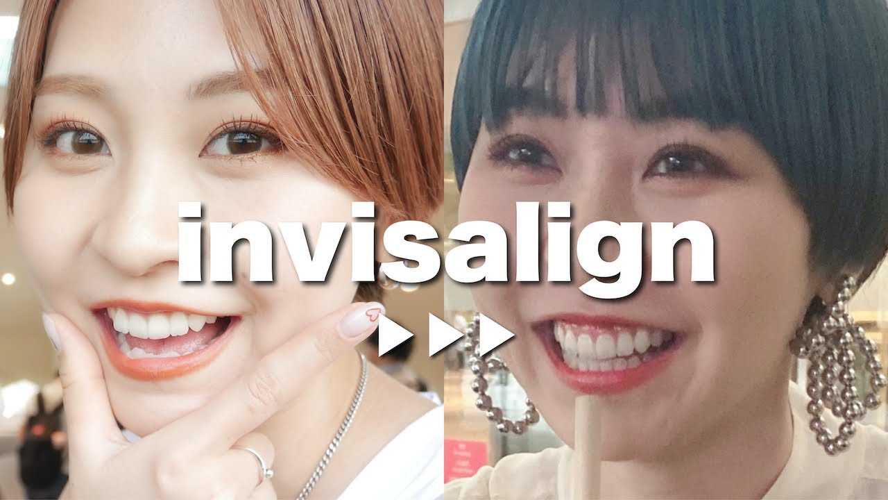 インビザライン矯正の経過🦷🪥