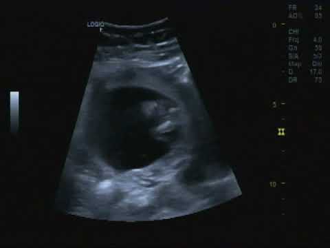 SieuAm NHƯ HUỲNH THỦY TIÊN 1996 Tân quới, Thai khoảng 13 tuần 03 ngày-Pk Bs Trần Thị Út Hai