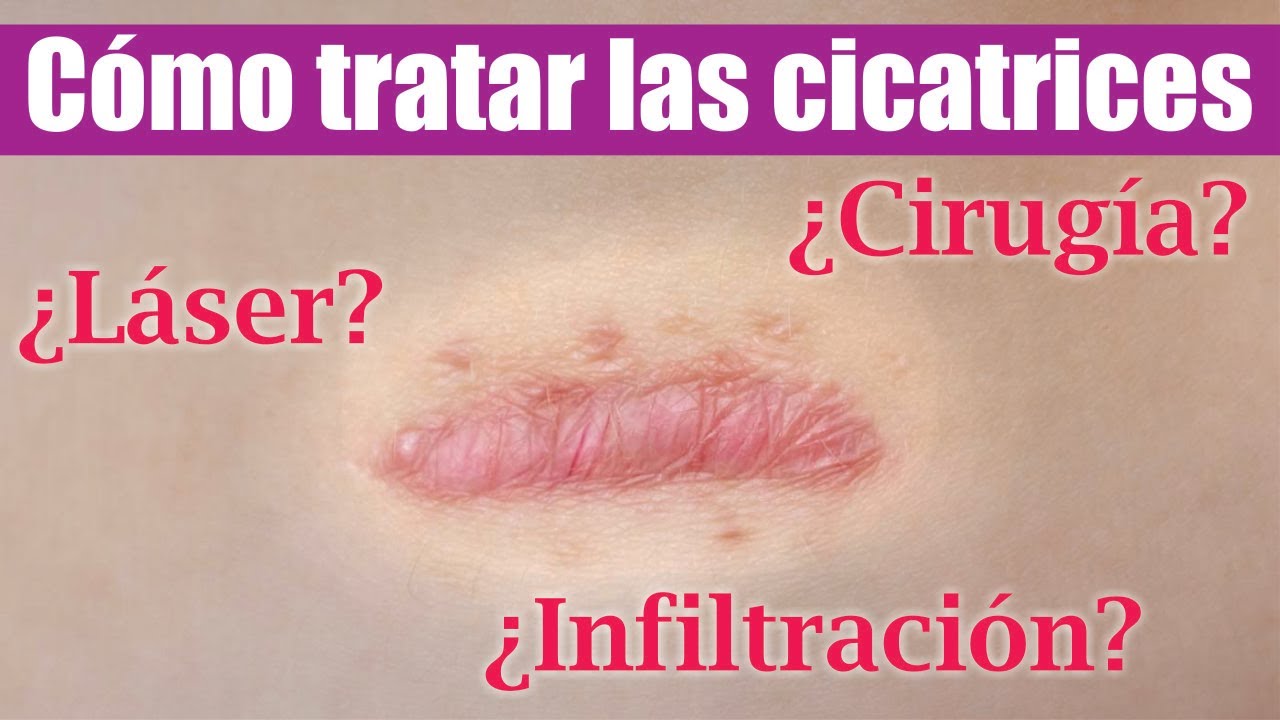 Watch TRATAMIENTO para CICATRICES ❤️ Infiltración cirugía y láser 👍🏼 DR PERCY NEVADO Cirugía Plástica Now TRATAMIENTO para CICATRICES ❤️ Infiltración cirugía y láser 👍🏼 DR PERCY NEVADO Cirugía Plástica