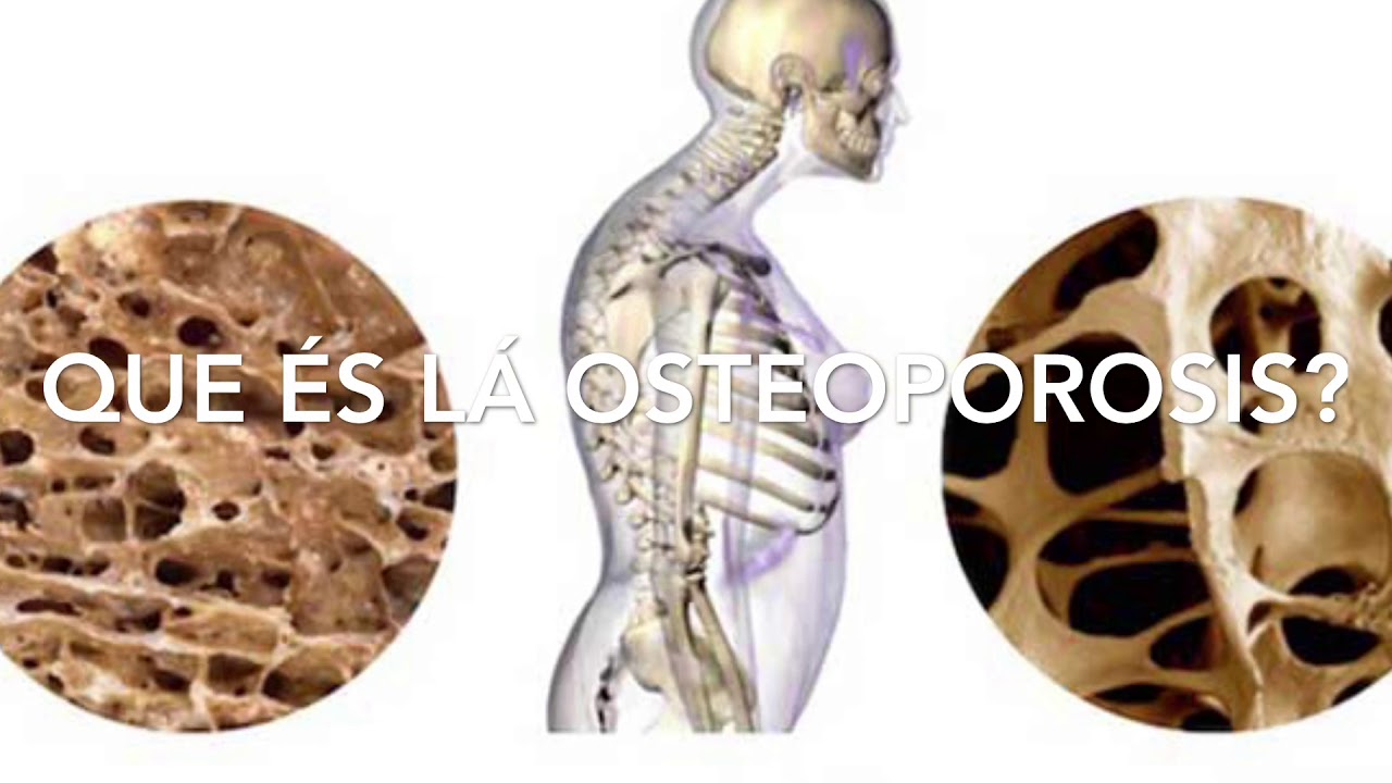 Que es la Osteoporosis