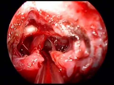 Pituitary Gland Intervention