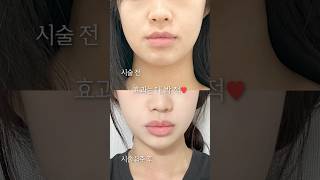 다이어트를 해도 이중턱은 그대로라면?