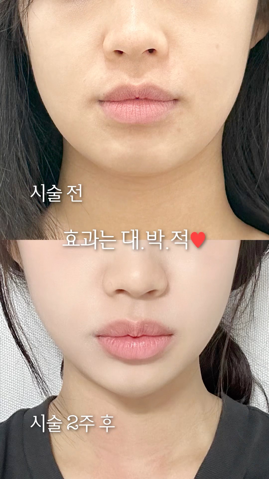 다이어트를 해도 이중턱은 그대로라면?