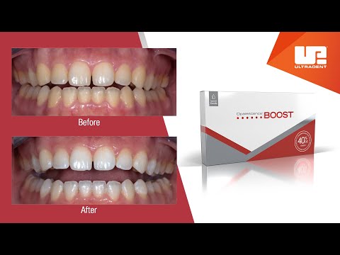 Video showing the Boost whitening process