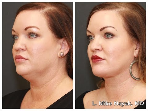 download lagu mp3 mp4 Chin Tuck Surgery, download lagu Chin Tuck Surgery gratis, unduh video klip Chin Tuck Surgery