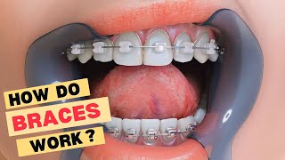 How do braces work ? #shortvideo