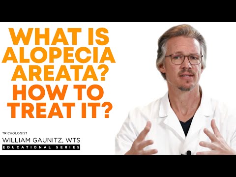 Alopecia Areata Signs, Causes, and Treatment | Road to Alopecia Areata Recovery