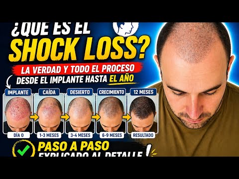 David explica el shock loss mes a mes tras un injerto capilar, con fotografías reales del proceso de recuperación