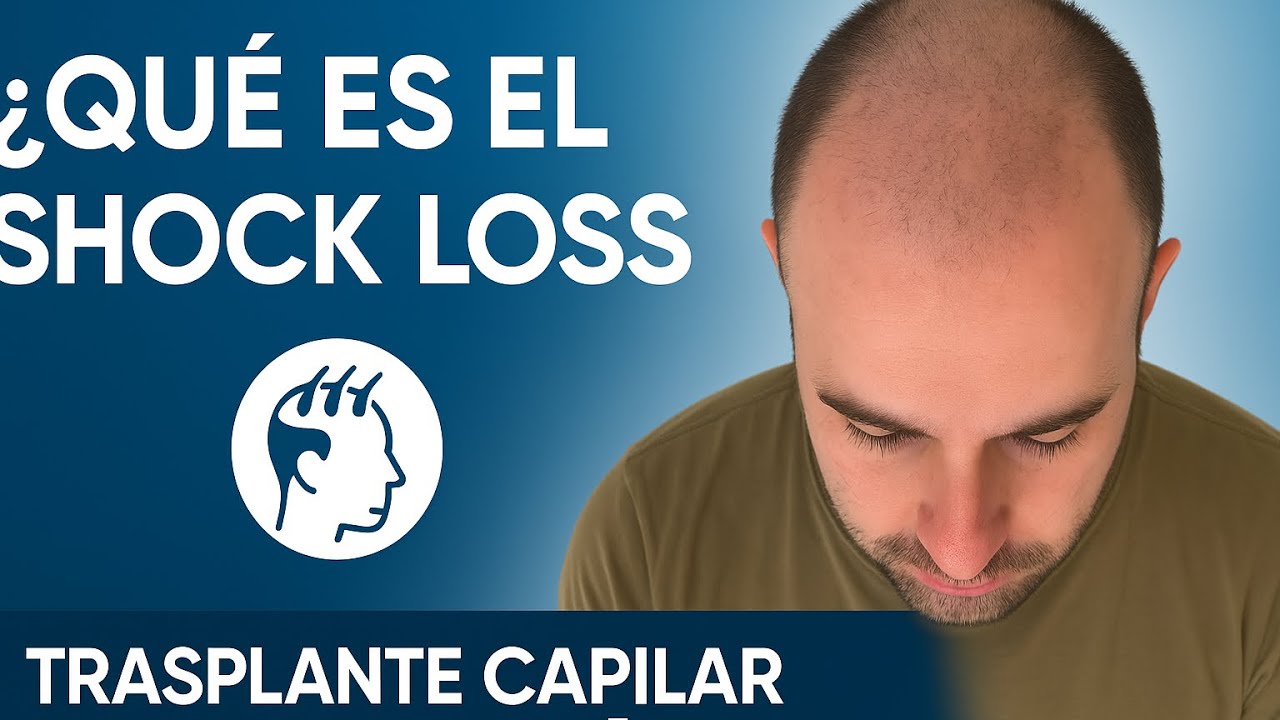 Lo que te va a pasar después de un injerto capilar SHOCK LOSS