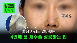 EDITION TV - 누가 봐도 수술한 티 나는 코 | 코 수술만 4번 한 이유 알고 보니