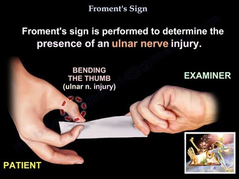 Froment-Zeichen – Alles, was Sie wissen müssen – Dr. Nabil Ebraheim