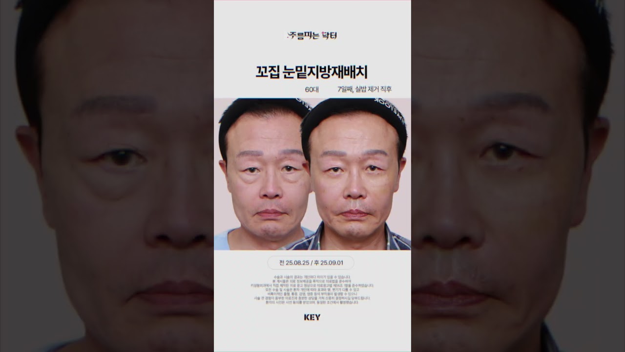 60대 꼬집 눈밑지방재배치 7일후