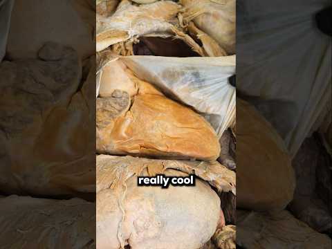 The Worst Heart Disease #heart #hearthealth