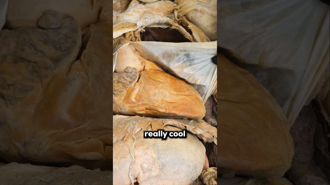 The Worst Heart Disease #heart #hearthealth