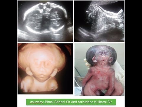 CONJOINED TWIN ULTRASOUND ( CRANIO-THORACOPAGUS)