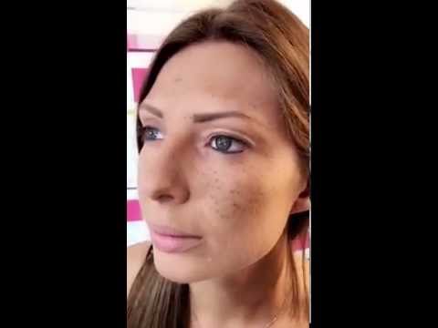 La crema che candeggia pigmentary nota akhromin Il sole con lentiggini una colorazione