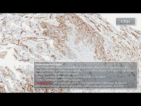 Epithelioid Hemangioendothelioma (Lung)