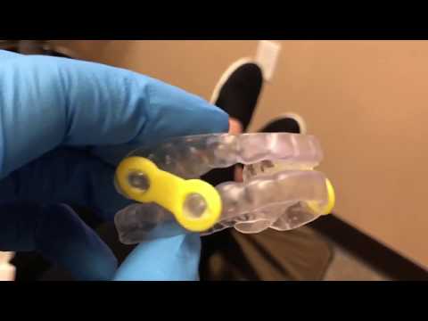 Sleep Apnea EMA Device