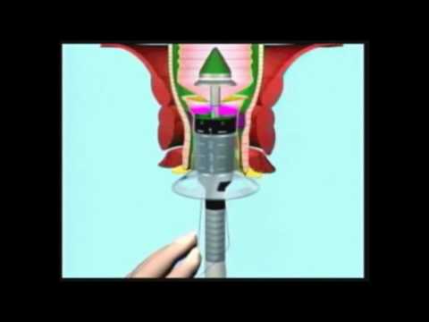 Stapler Surgery for Piles Video by Healing Hands Clinic, Pune