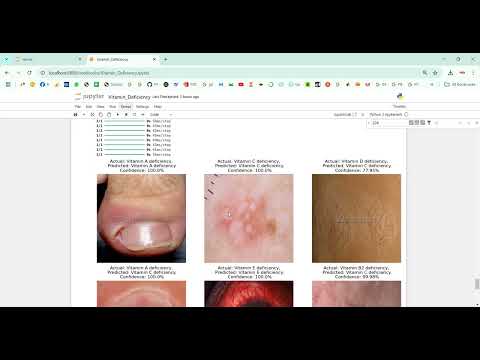 Vitamin Deficiency Detection Using Image Processing in Python Projects