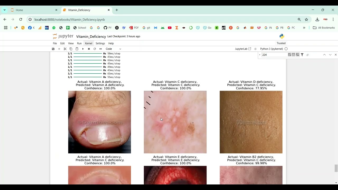 Vitamin Deficiency Detection Using Image Processing in Python Projects