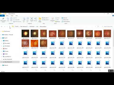 Glaucoma Disease Prediction Image Classification Streamlit in Python Projects
