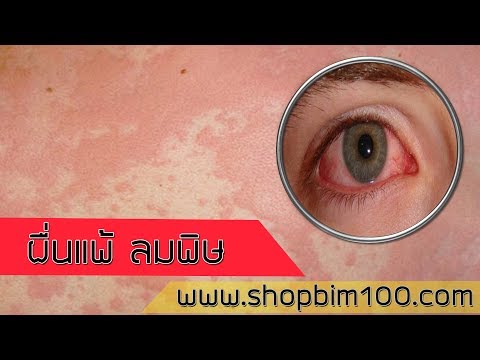 จุดเช่นโรคสะเก็ดเงิน โรคสะเก็ดเงินในสิ่งที่ภรรยา