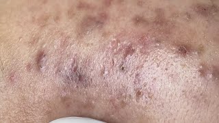 [問卦] Blackpink的黑頭粉刺值錢嗎？