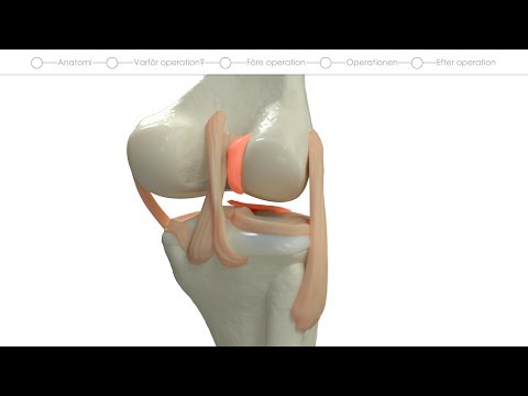 Patientfilm om främre korsbandsrekonstruktion