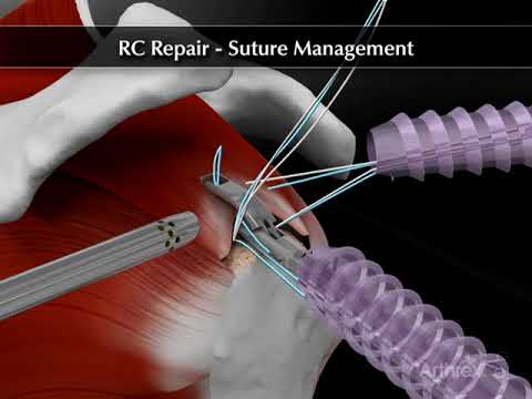 RC Repair Suture Management