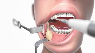 IPS Implants® Orthognathics