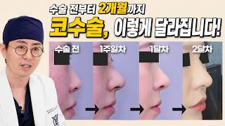 수술 전~2개월까지 코수술 변화, 언제 어떻게 달라질까?