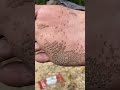APAKAH KALIAN PERNAH MELIHAT KAKI BOLONG BOLONG Shorts Trendingshorts Pitteskeratolysis