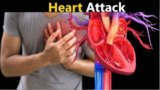 Heart Attack |myocardial infarction  6 signs of heart attack a month before